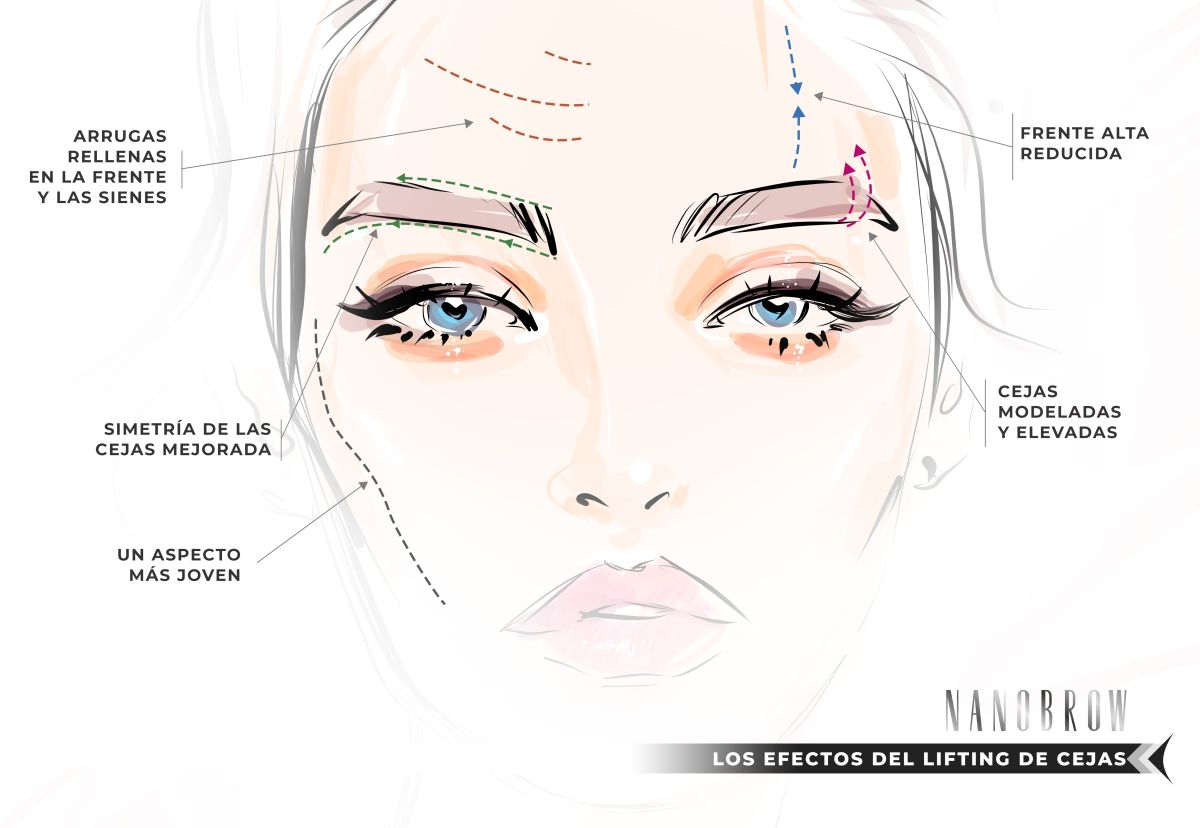 Los efectos del lifting de cejas: Un aspecto más joven, Frente alta reducida, Arrugas rellenas en la frente y las sienes